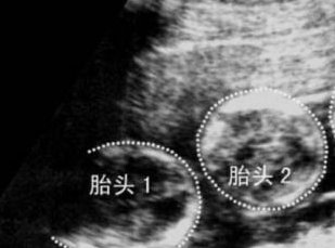 武汉同济医院三代试管的费用是多少？附费用明细情况